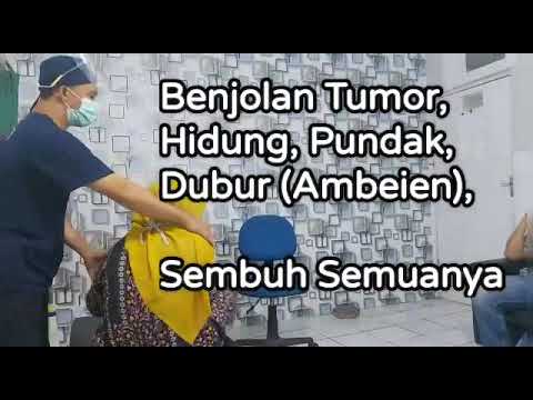 Terapi benjolan di hidung polip, tumor di pundak, ambeien pada pasien ini sembuh semuanya