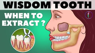 Wisdom Teeth Removal / When to extract Wisdom teeth (Third molar) / Animation // Medinaz screenshot 5