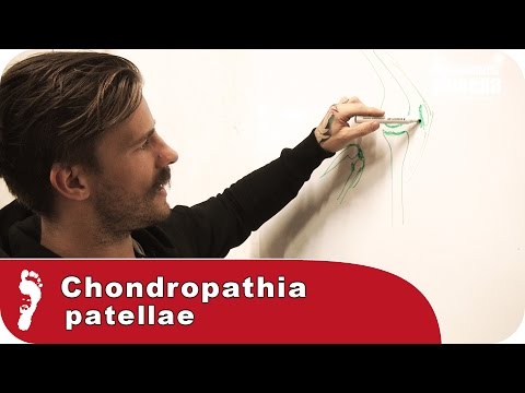 Video: Kann Chondromalazie Patella schlimmer werden?