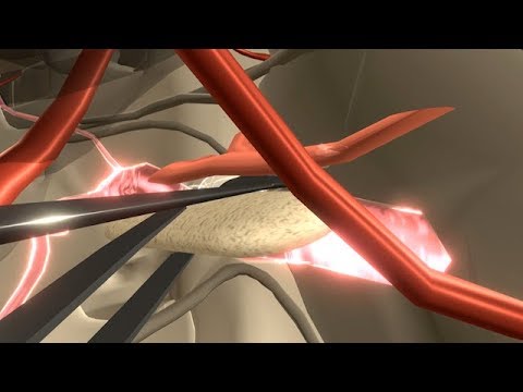 Video: Neuralgia Dada