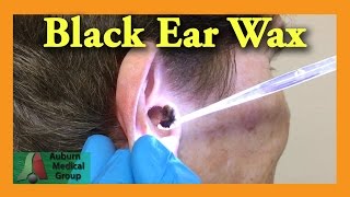 Black Ear Wax Removal | Auburn Medical Group