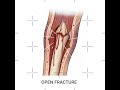 Open Fractures