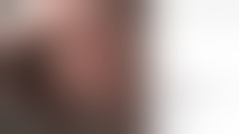 FTRD® System | Hybrid FTRD | Resection of recurrent sigmoidal adenoma