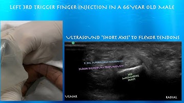 Ultrasound Guided Trigger Finger Injection by probeultrasound.com