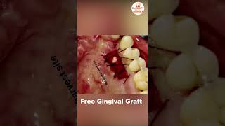 Resolving Gum Recession With Free Gingival Graft | Best Dental Hospital In India | Eledent Hospitals screenshot 2