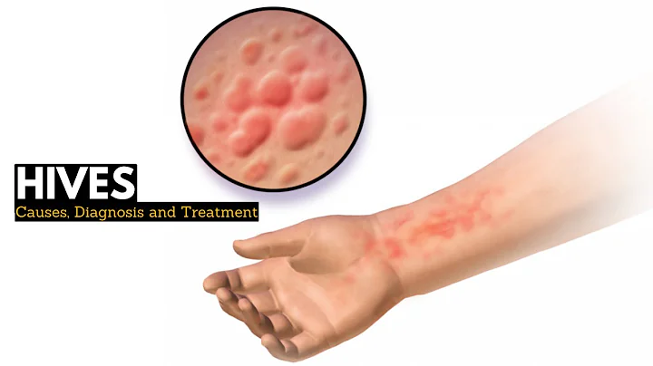HIVES, Causes, Signs and Symptoms, Diagnosis and Treatment. - DayDayNews