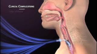 Clinical Complications of Tracheostomy