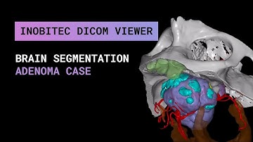 Brain segmentation in Inobitec DICOM Viewer Pro (Adenoma case)