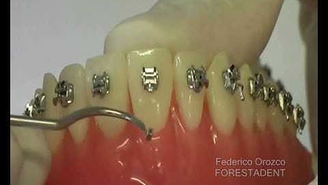 FORESTADENT QUICK - How to remove the clip part 02