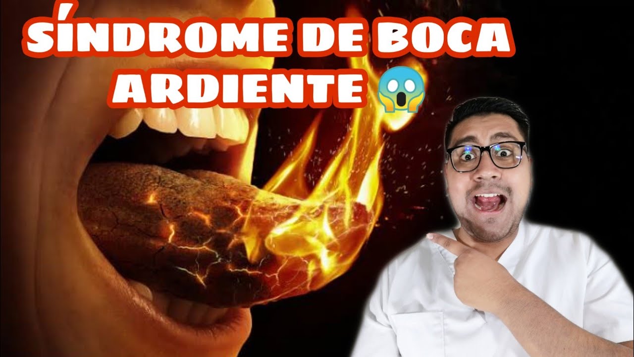 Ceu Da Boca Ardendo Ao Comer SINDROME DE BOCA ARDIENTE- CAUSAS Y ¿TRATAMIENTO? - YouTube