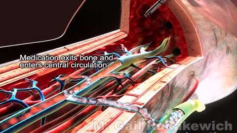 Manual Intraosseus Needle Insertion