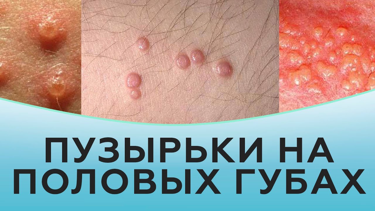 малые половые губы жены ФОРМА ПОЛОВЫХ ГУБ У женщин форма и очертания половых губ сугубо  индивидуальны. Они могут варьировать в значительных пределах от правильных,  идеальных до необычных очертаний, щедро одаренных затейницей-природой, и  какого-либо значитального влияния на