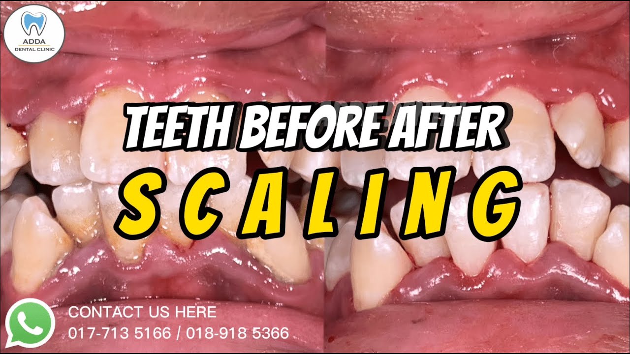 Teeth Before After Scaling Satisfying Cuci Gigi Scaling Dentist
