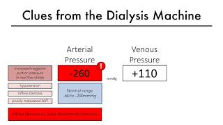 Hemodialysis Access 101 04 Part 2  Clues from the Dialysis Machine