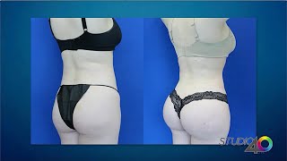 Dr. Dennis Dass TruCurve Brazilian Butt Lift On Sacramento TV