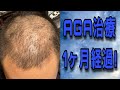 AGA治療1ヶ月経過！夢ではなく現実を見ます… #AGA治療 #薄毛 #育毛