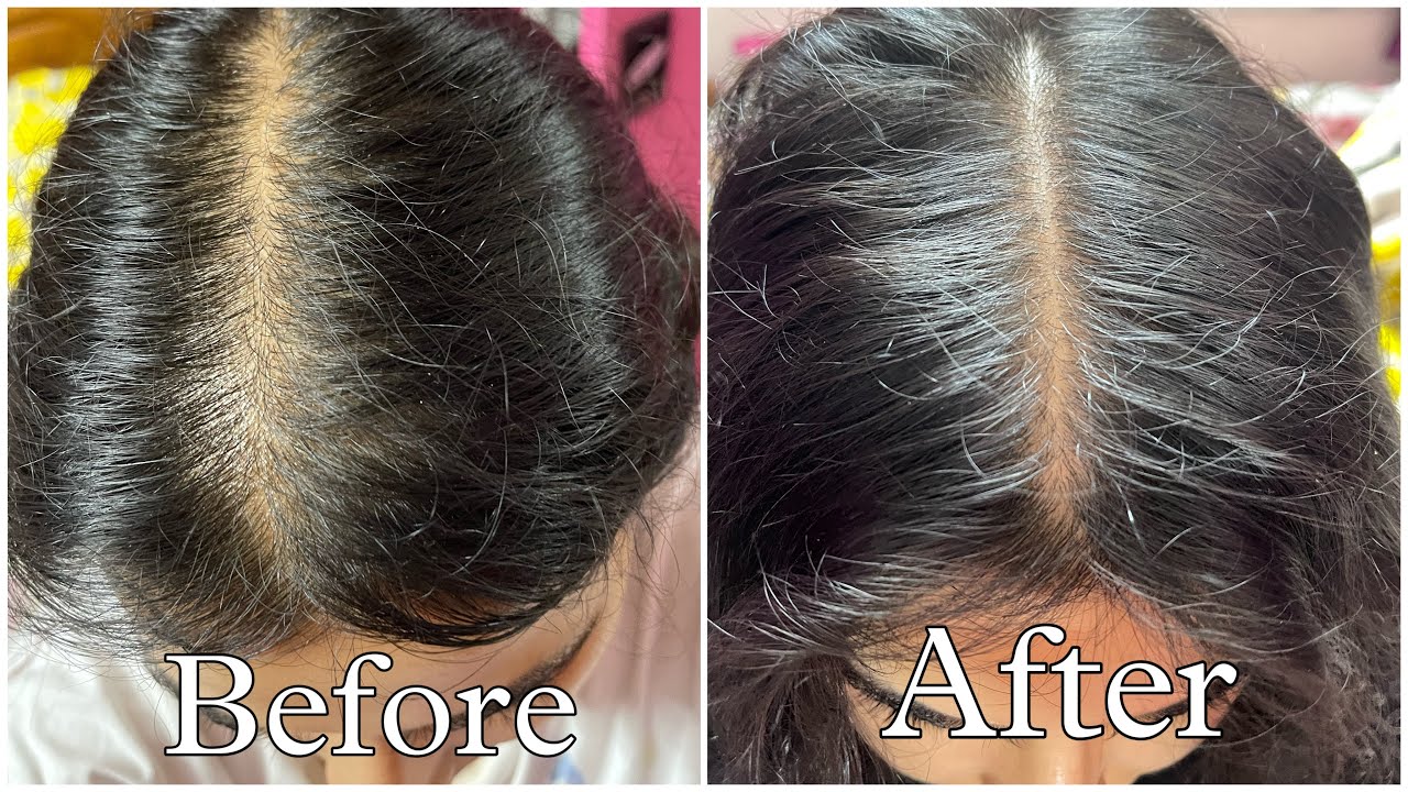 Supplements I take for Hair loss & Faster Hair Growth #hairgrowth