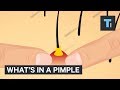 Whats inside a pimple