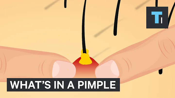 What's Inside A Pimple? - DayDayNews