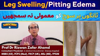 Leg Swelling / Pitting Edema – Don’t Ignore This Warning Sign!