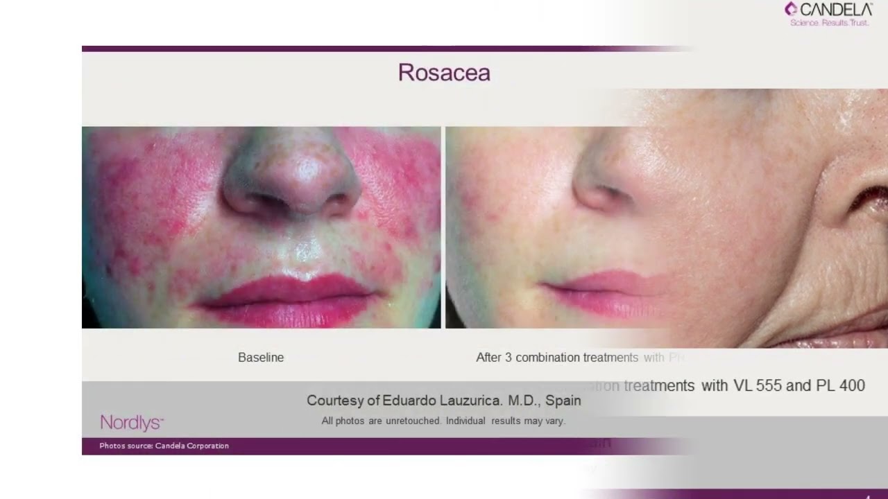 Rosacea laser | QC Skin Clinic