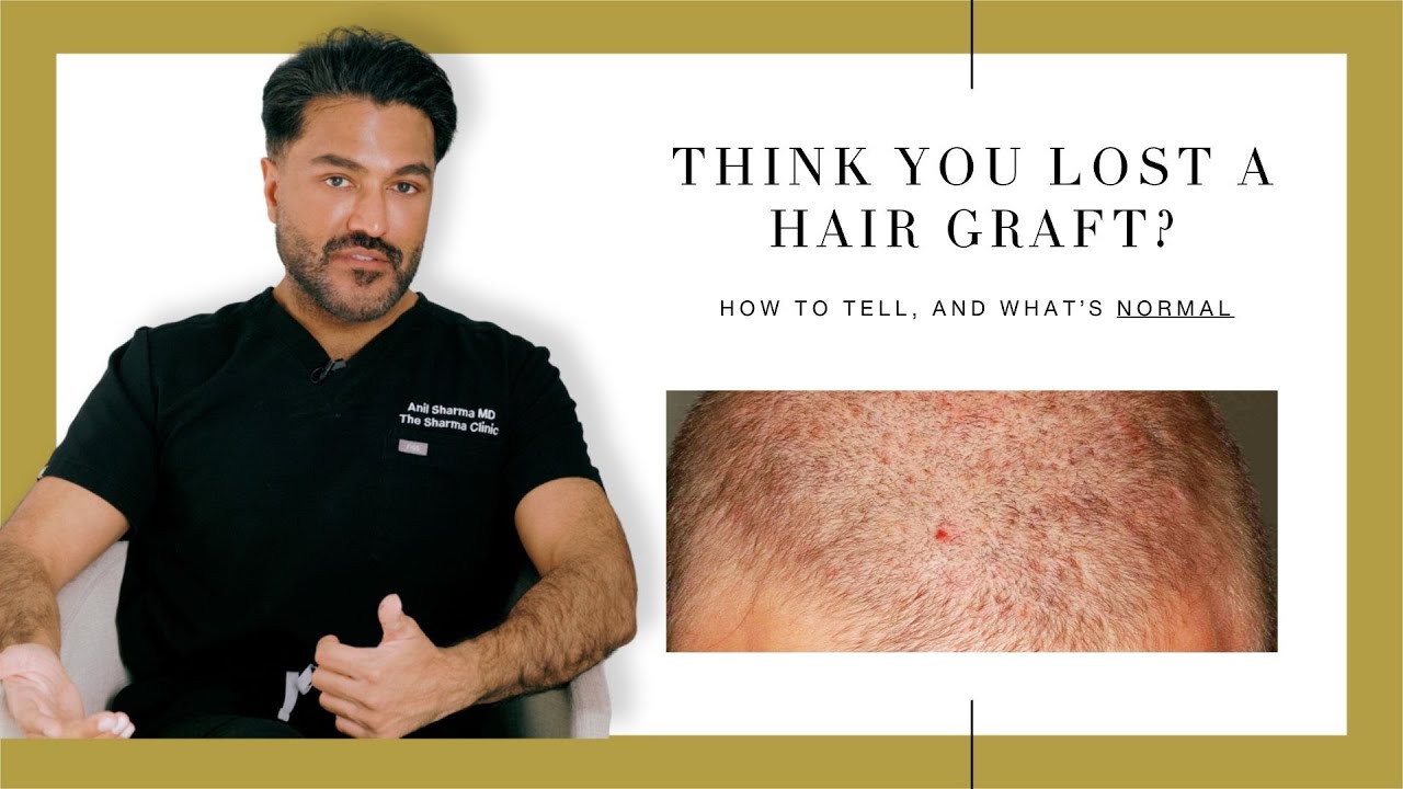 Have You Lost A Hair Follicle After Your Hair Transplant? Here's How To Tell.