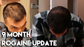 9 Month Rogaine Update (Minoxidil) - Slowly Coming Back