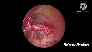Endoscopic Stapedotomy using Soft Clip Titanium piston with local anaesthetisa 