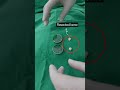 Dr.kirk Insoo Autologous Bone Graft #shorts