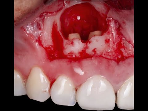 Como drenar um abscesso vídeo-Short dental (Dr. Shihab Romeed)