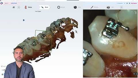 How to Virtual bracket Delete