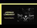 Hernias lumbares - Resonancia Magnética