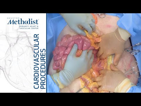 Entering the Abdomen & Taking Down Adhesions on a Cadaver (Alan B. Lumsden, MD, Edward Andraos, MD)