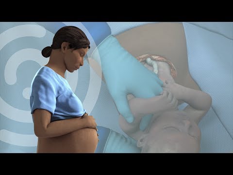 Touch Surgery Simulation - Cesarean Section (Patient information video)