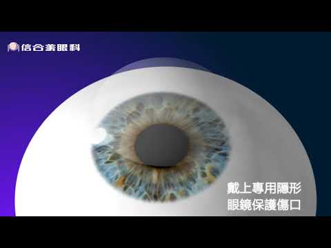 Trans PRK手術過程