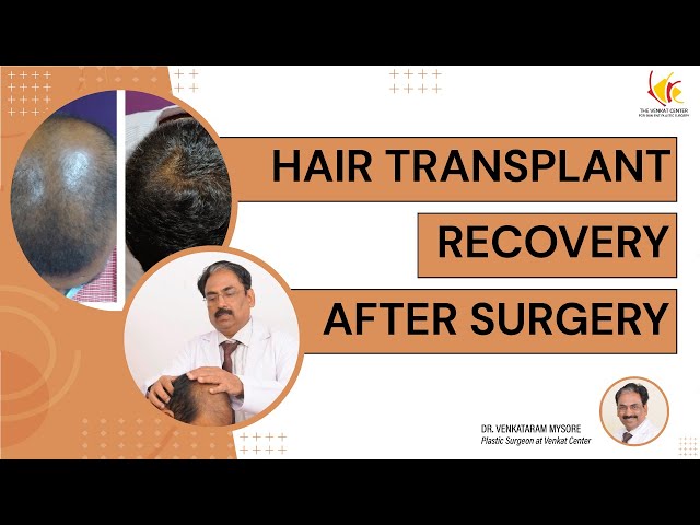 Recovery Stage after hair transplantation | Important points about post-hair transplant procedure