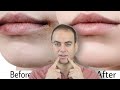 تفتيح التصبغات حول الفم بطريقة فعالة 