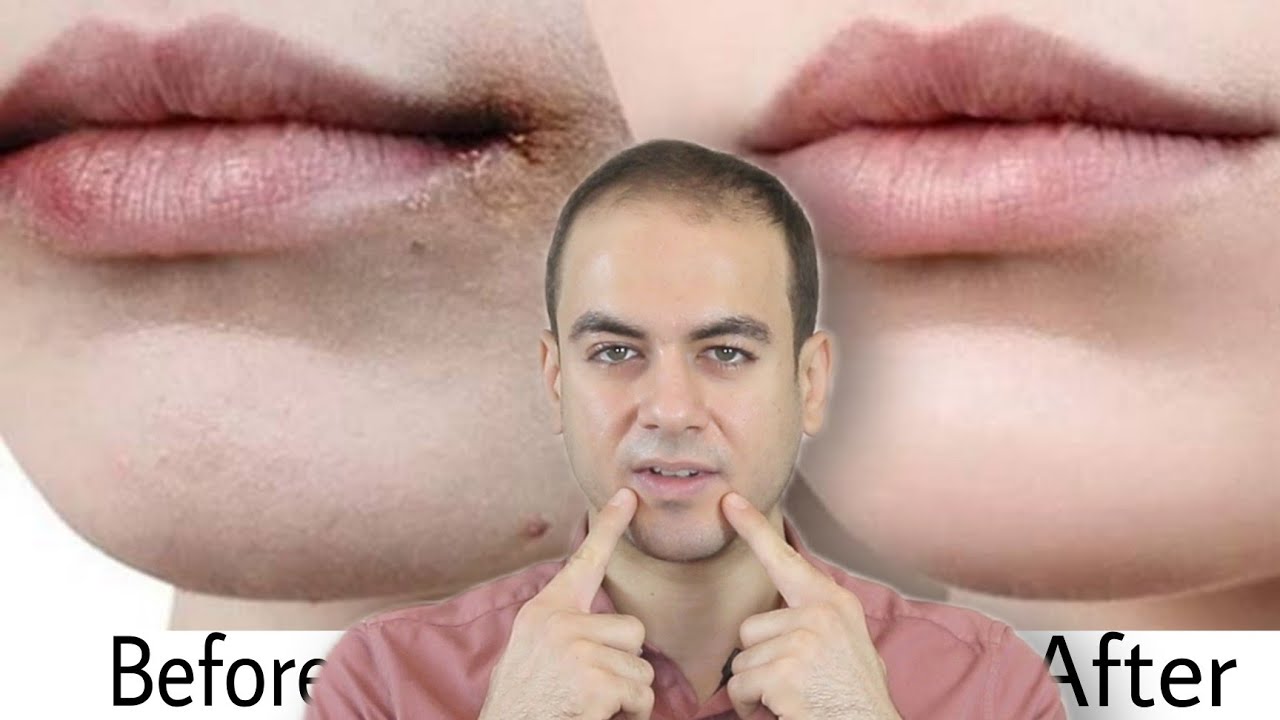 Эффективно осветляет пигментацию вокруг рта