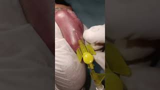 New born baby IV Vigo fixing in hospital|IV Vigo video| #vigovideo #viral #shorts #baby #nurse #vigo