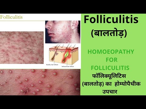 FOLLICULITIS TREATMENT IN HOMOEOPATHY /बालतोड़ का होम्योपैथीक उपचार #Folliculitis #Homoeopathy#बालतोड़