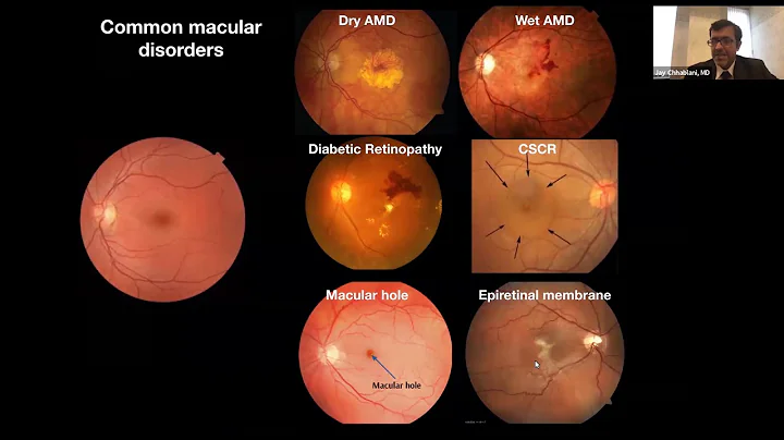 Sight + Sound Bites: Imaging the Eye to Diagnose and Treat Macular Disorders