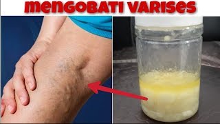 Download lagu cara mengobati varises menggunakan bahan alami cara mengobati varises menggunakan bahan alami
