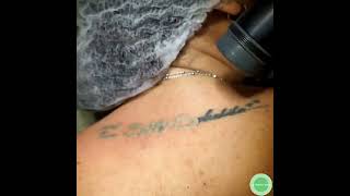 Rimozione Tatuaggi Ad Arzano