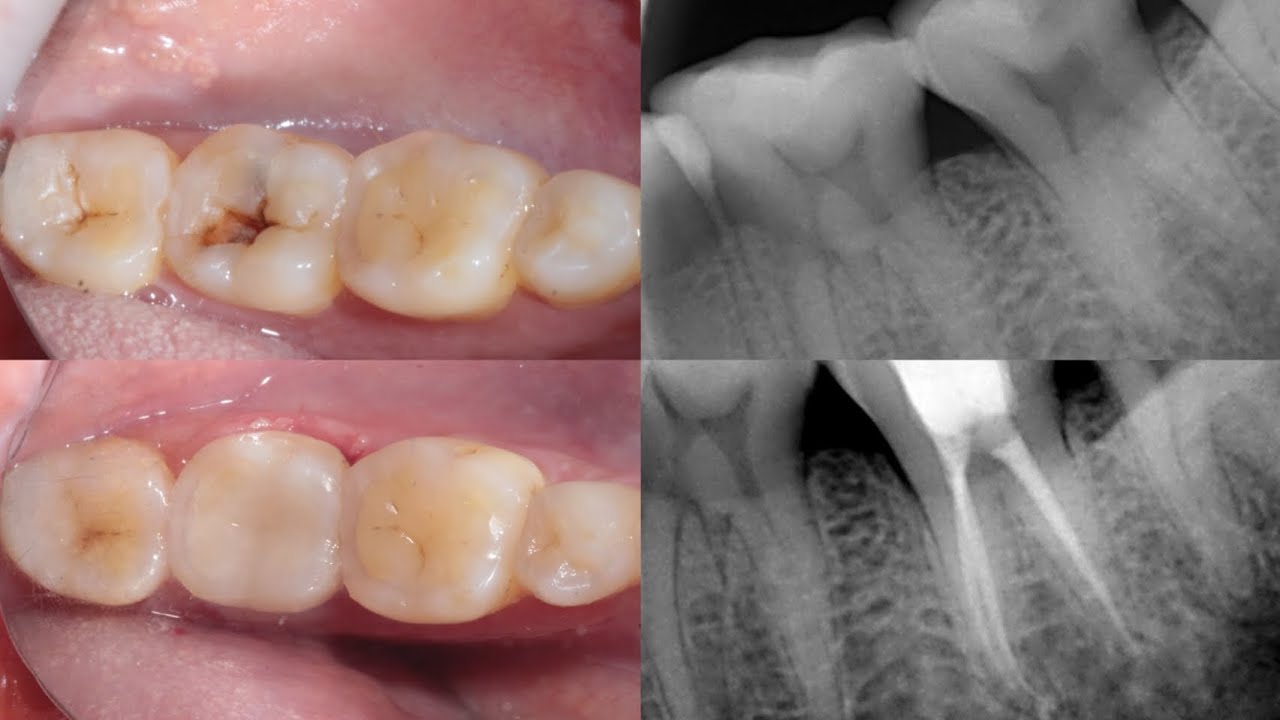 Root canal treatment explained step wise | RCT and permanent natural ...