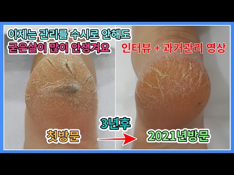 직접 관리 없이 약 1년 만에 오셨는데 심해지지 않아서 이정도면 만족하신 고객님 굳은살제거 각질제거 [푸스올영등포당산점]