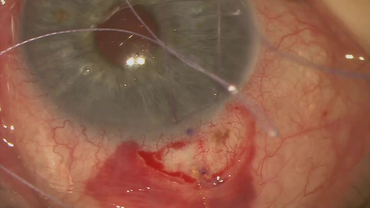 Dr. Bedrood - Ab Externo Xen Stent Open Conjunctiva