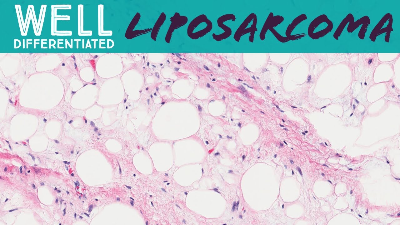 Well Differentiated Liposarcoma Aka Atypical Lipomatous Tumor