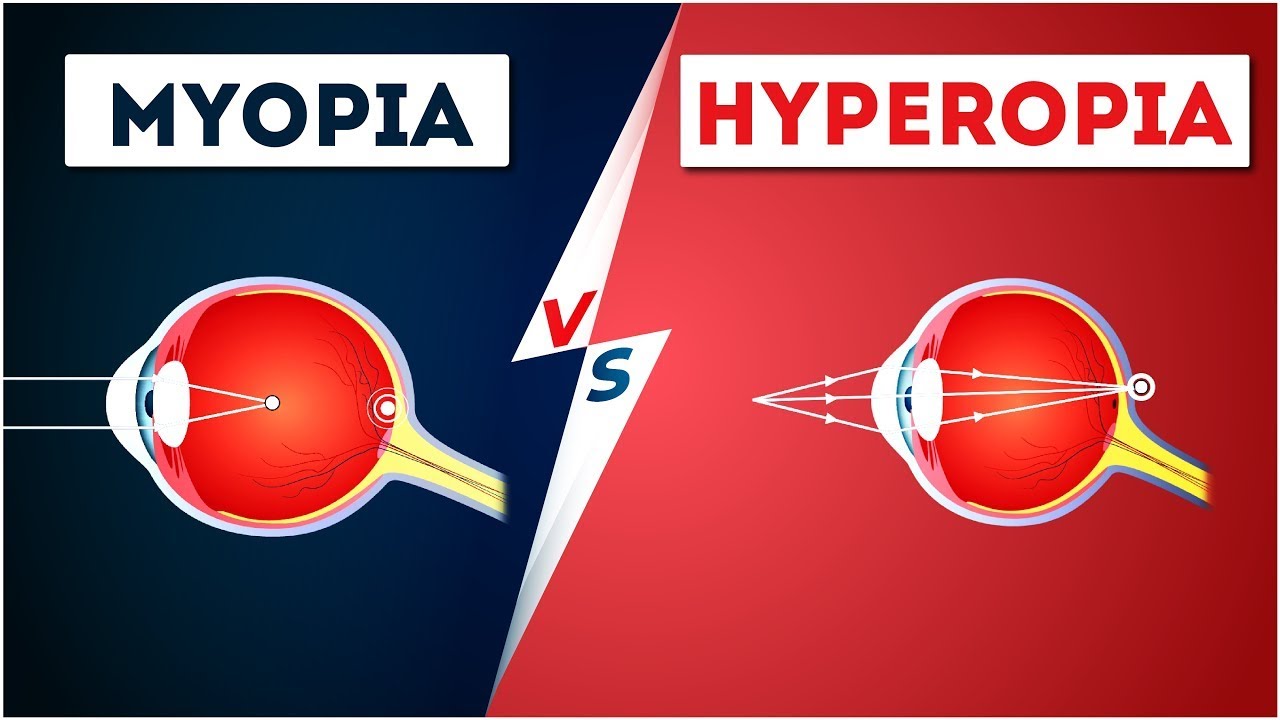 látásélesség hyperopia myopia