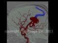 AVM - arteriovenous malformations in the brain & cerebral hemorrhage- animation by Cal Shipley, M.D.