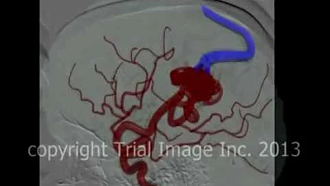AVM - arteriovenous malformations in the brain & cerebral hemorrhage- animation by Cal Shipley, M.D.